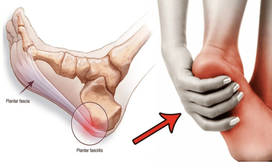 Plantar Fasciitis: Treatment options for your painful heel(s): Orthopedic  Center for Sports Medicine: Sports Medicine Physicians